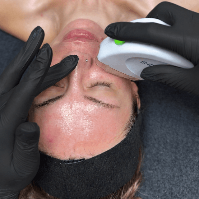 Lush Skin Renewal RF & FSR-4 Sess. at Lush Aesthetics in Englewood, OH