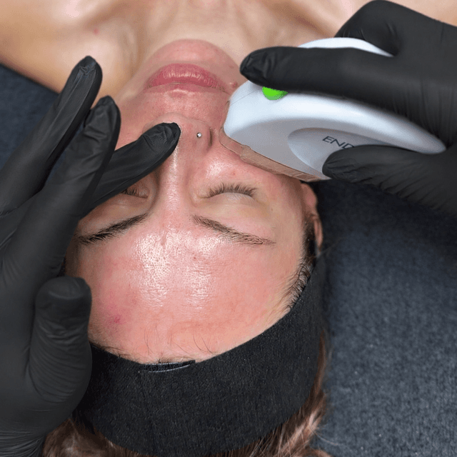 Lush Skin Renewal RF & FSR-6 Sess. at Lush Aesthetics in Englewood, OH